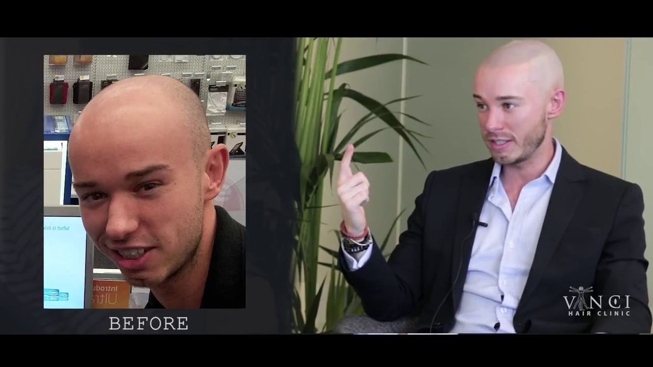Scalp Pigmentation Gone Wrong and How To Get it Right - Vinci Hair Clinic