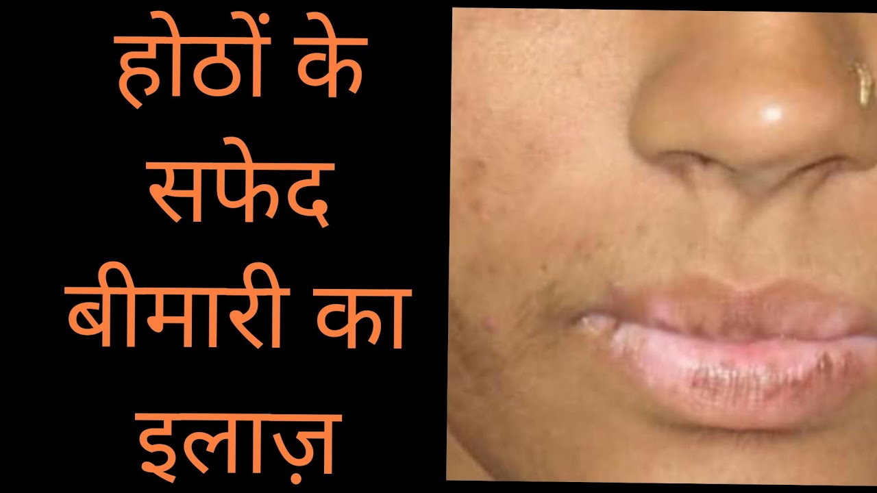 lip leukoderma || Lip White Skin || होंठो के सफेद दाग