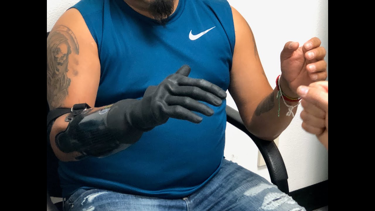 Ossur i-Limb&reg; Prosthetic Demonstration