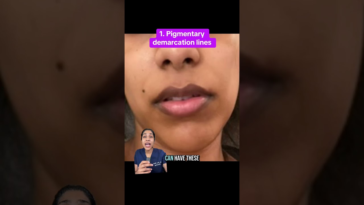 Darkness/discoloration around the mouth? Here&rsquo;s what it causes it and how to fade it, from a derm