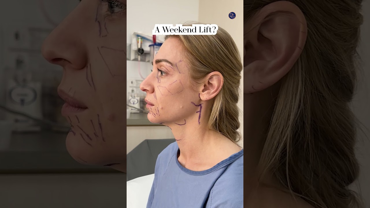 Natural Results| Weekend Lift 2 Week Post-Op| Before and After