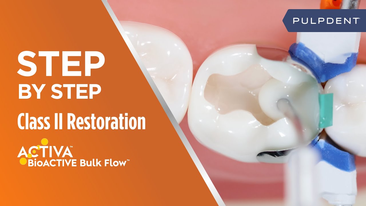 Step by Step Class II Restoration with Activa BioACTIVE Bulk Flow