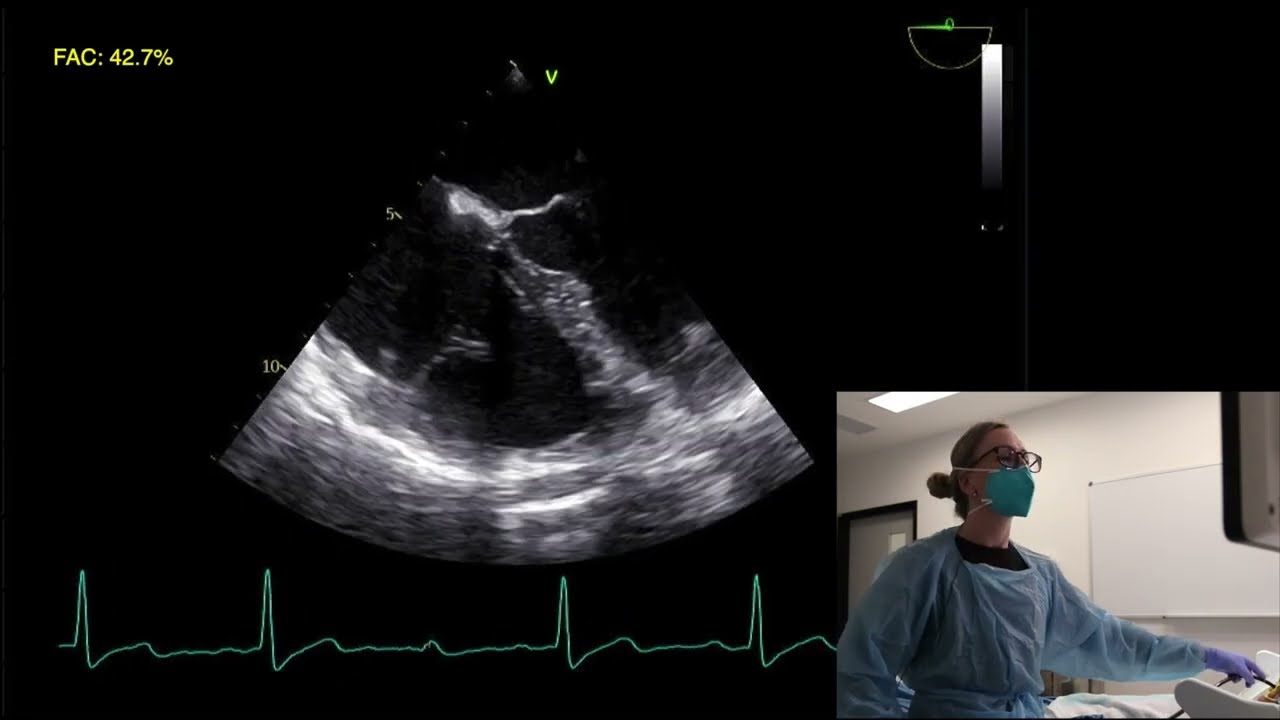 Ep 8: Basic TOE/TEE assessment of the right ventricle