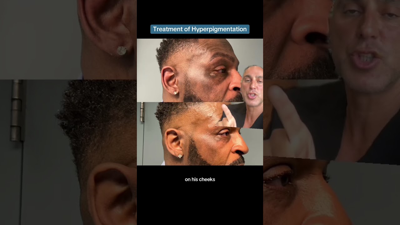 Treatment of Hyperpigmentation