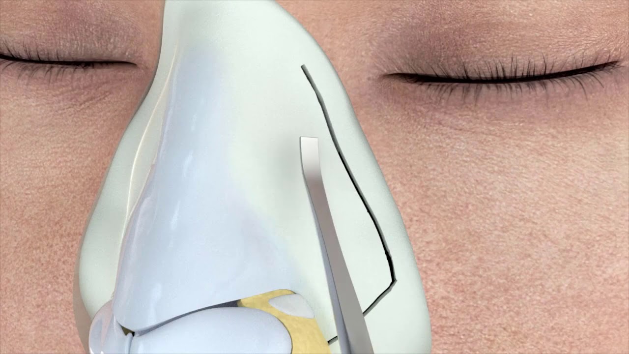 Rinoplastia ultrasónica (piezoeléctrica)