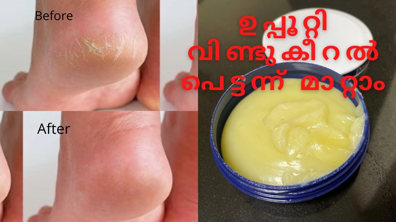 Fix Cracked Heels Fast || Homemade Cream to Treat Cracked Heels Naturally || Malayalam