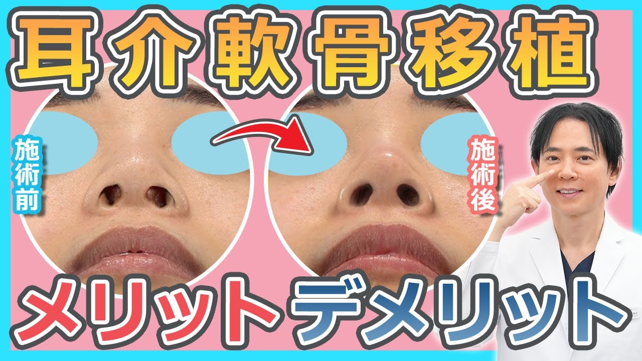 【鼻整形】耳介軟骨移植で自然で綺麗な鼻先に｜メリットやデメリットをお話しします