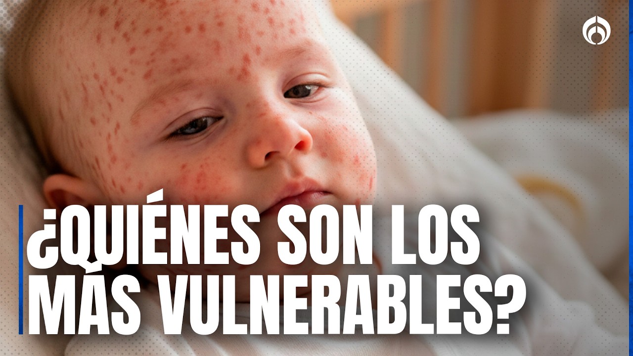 Sarampión: Los niños son prioridad para vacuna, advierte Doctor Alejandro Macías