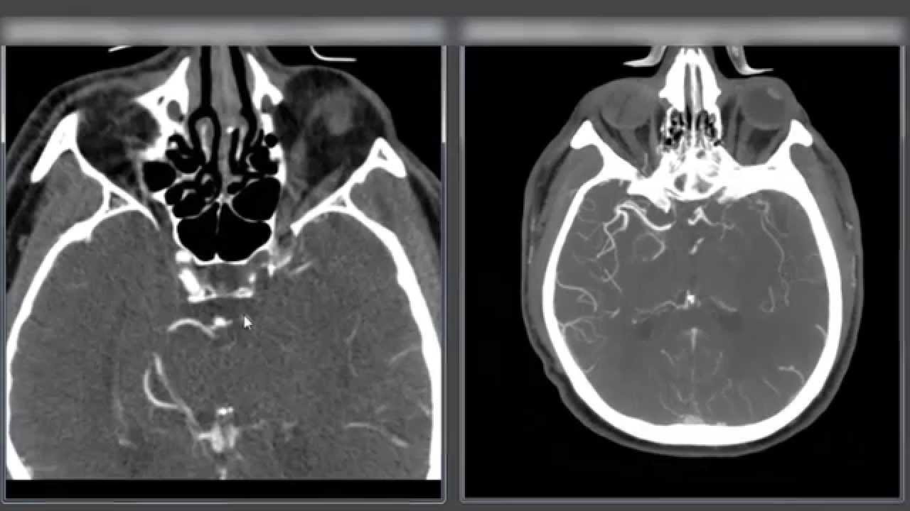 Large Artery Occlusion - ICA