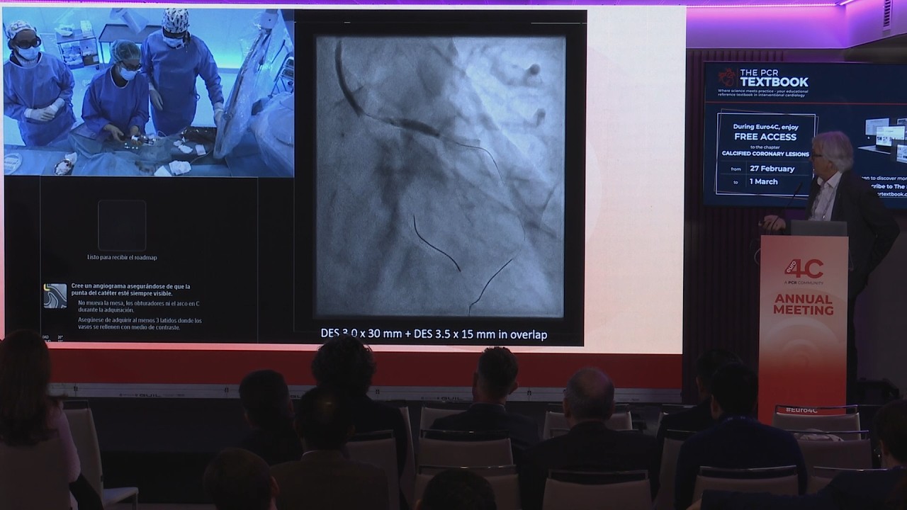 Novel Hertz Contact intravascular lithotripsy: calcium fragmentation with zero trade-offs