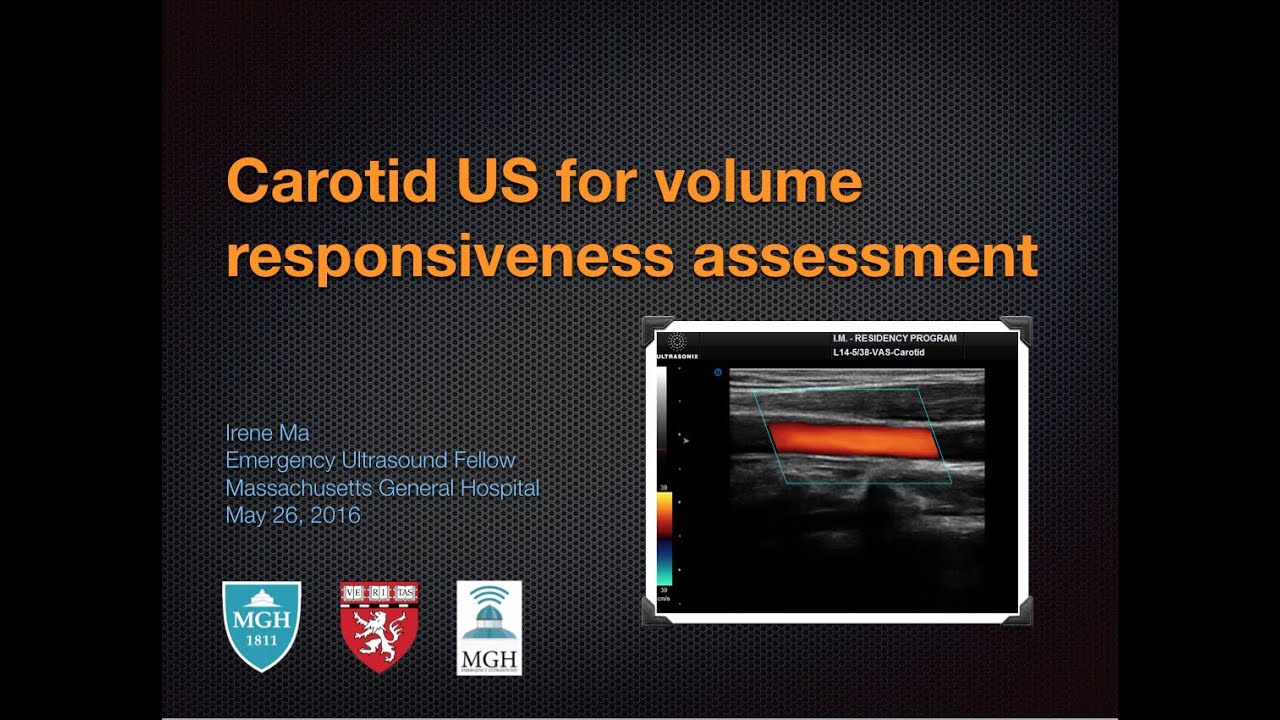 Carotid ultrasound for volume responsiveness assessment