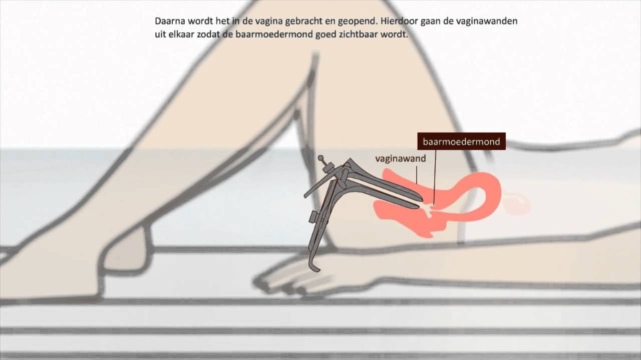 Uitstrijkje - Hoe wordt een uitstrijkje gemaakt?