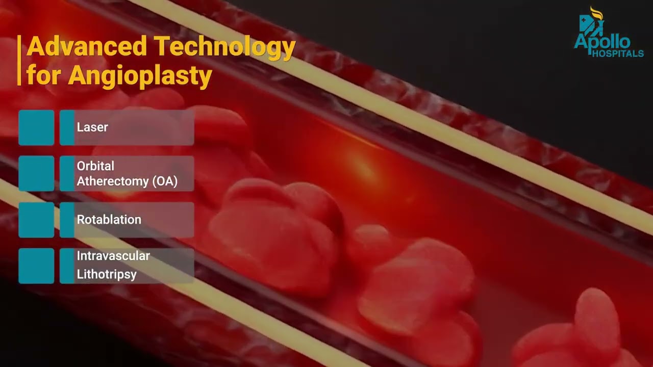 Angioplasty vs Bypass Surgery | Which Is Right for You?