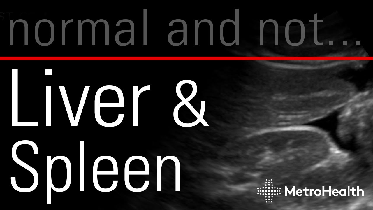 Liver & Spleen: Normal and Not