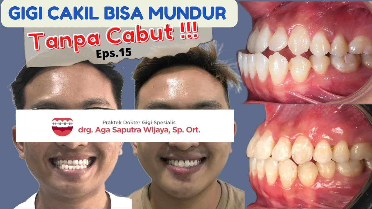 Gigi Cakil (gigi bawah maju ke depan) Bisa Mundur Tanpa Cabut!!! Eps. 15