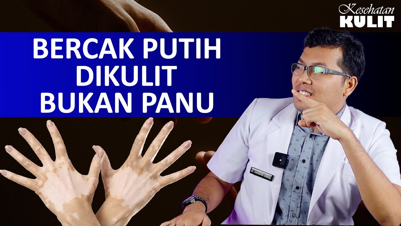 VITILIGO BERCAK PUTIH DIKULIT - DOKTER SADDAM ISMAIL