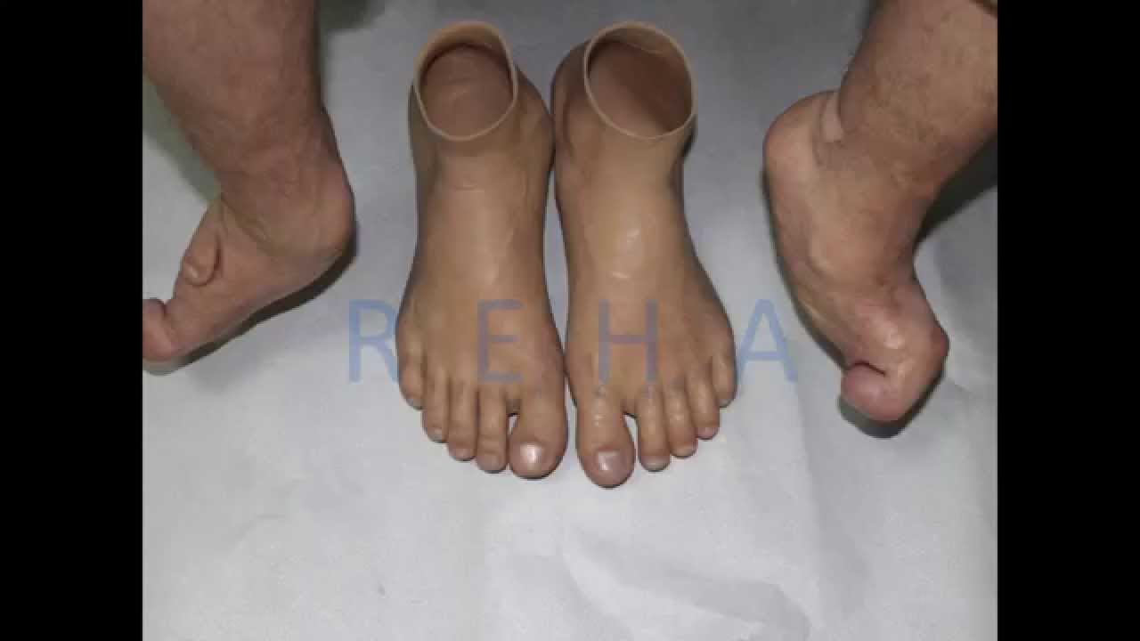 Ön Ayak Protezi / Forefoot Prosthesis ( Chopart Pirogoff Lisfranc )