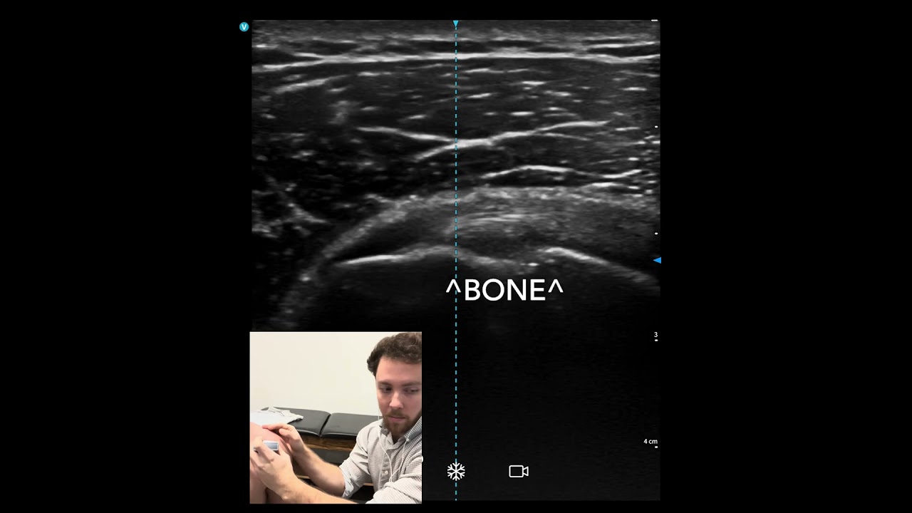 Ultrasound Scan of the Shoulder & Dry Needling