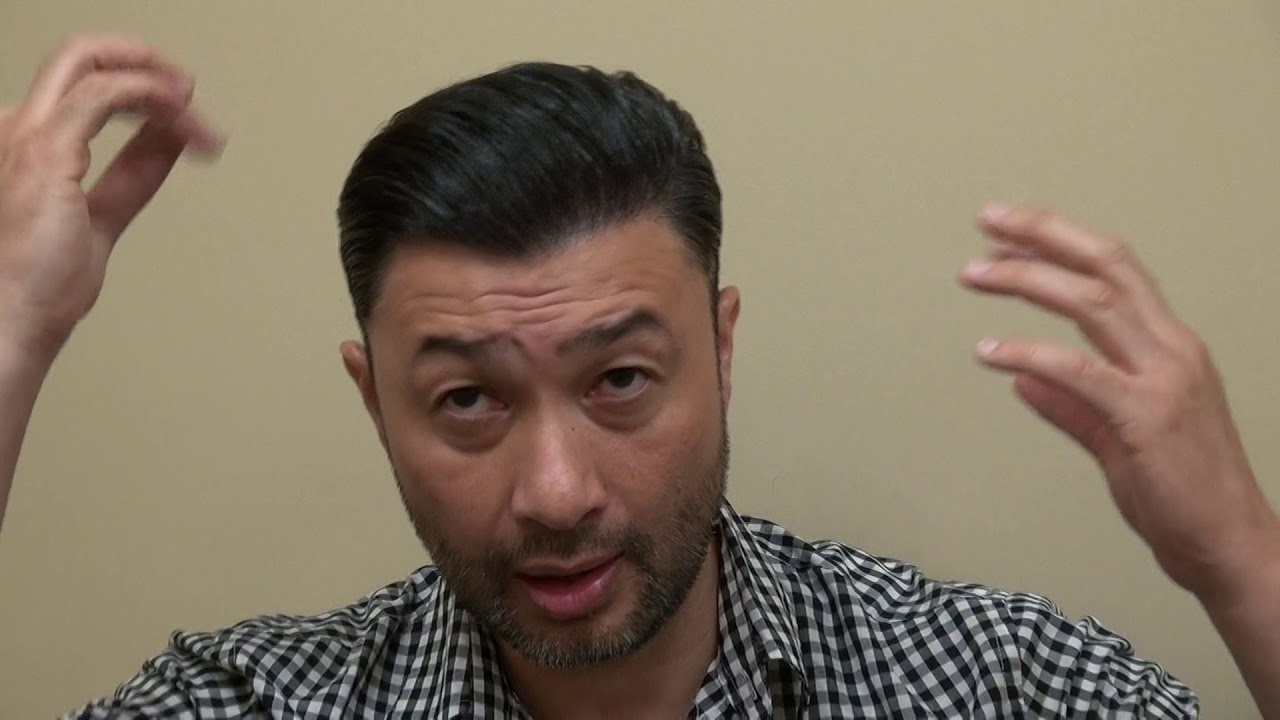 Hair Transplant 11th Month Follow Up Restoration Surgery Progress Dr. Diep http://www.mhtaclinic.com
