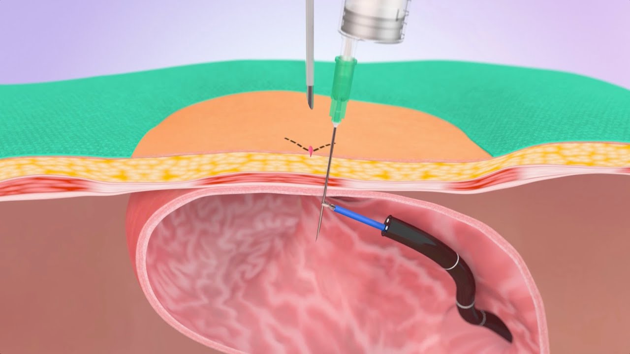 PEG Magensonde legen | Medizinische Animation