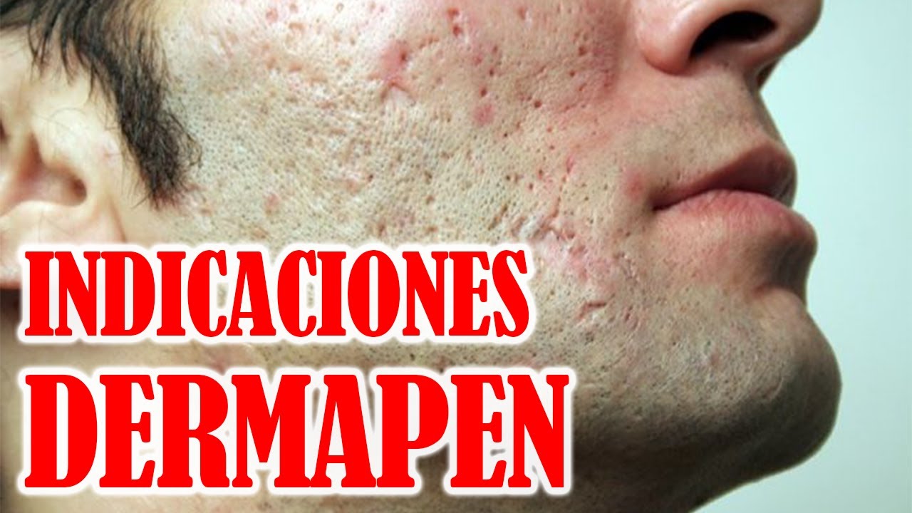 🟢 CLASE TEORICA DERMAPEN 👨‍⚕ : En que casos lo indicamos? TIPOS de CICATRICES DE ACNE, ANTIAGE