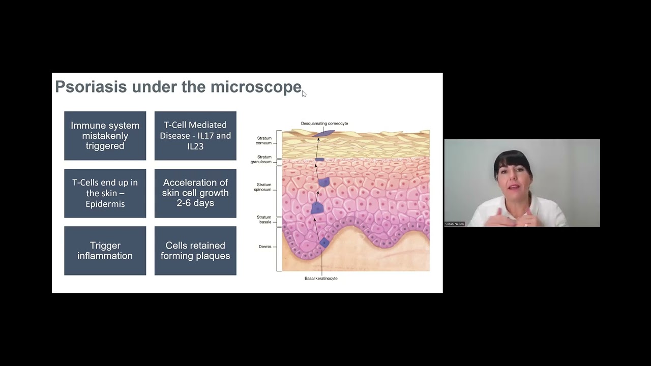 IDI Expert Webinar: Eczema and Psoriasis