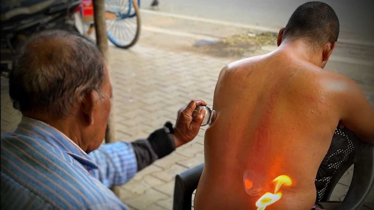 ASMR NARSA Baba Traditional Fire Cupping Therapy Instant Relief from Back-pain & Stress #painkiller