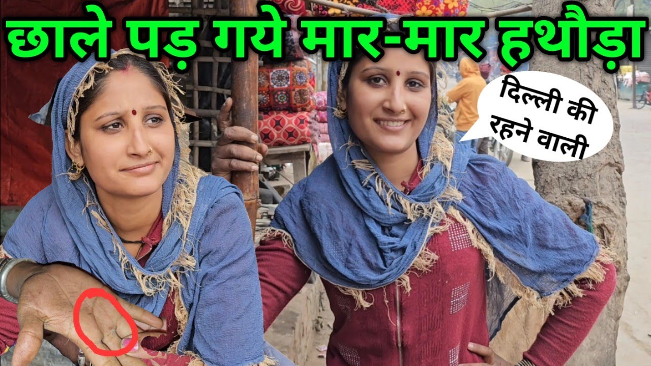 मार के हथोड़ा: छाले पड़ने का असली कारण क्या हैं? sharmila loharin ki life