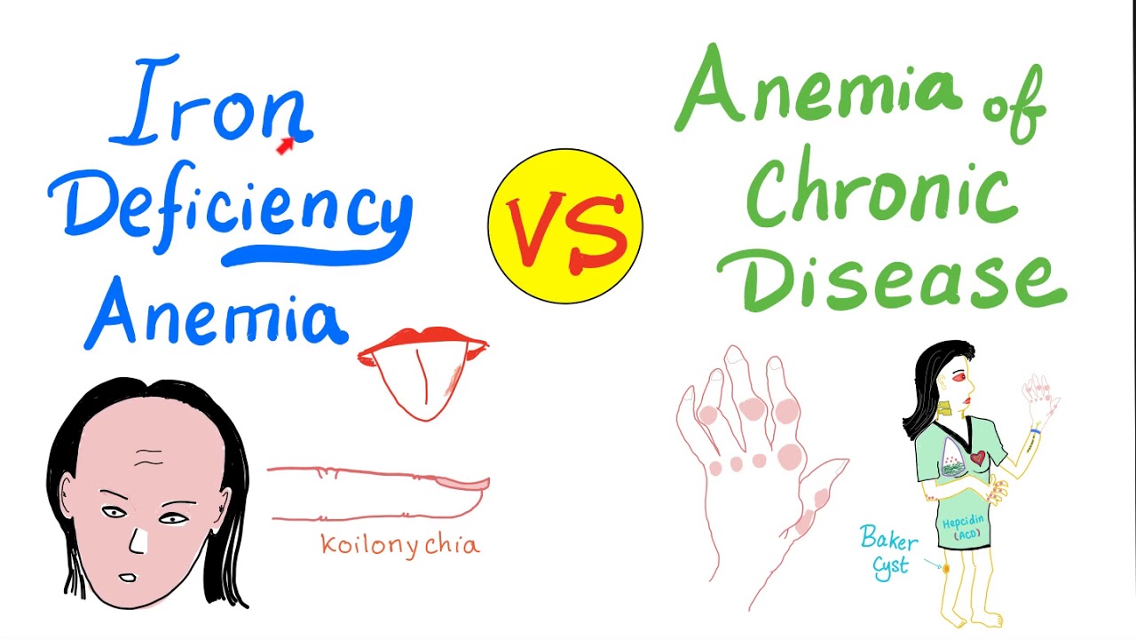 Iron Deficiency Anemia (IDA) VS Anemia of chronic disease (ACD)