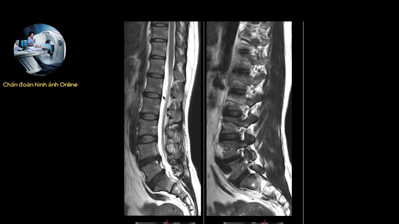 MRI CỘT SỐNG | PGS. TS. LÊ VĂN PHƯỚC