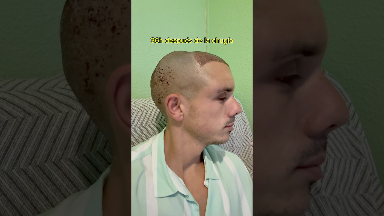 Cirug&iacute;a capilar (Cap&iacute;tulo 3)