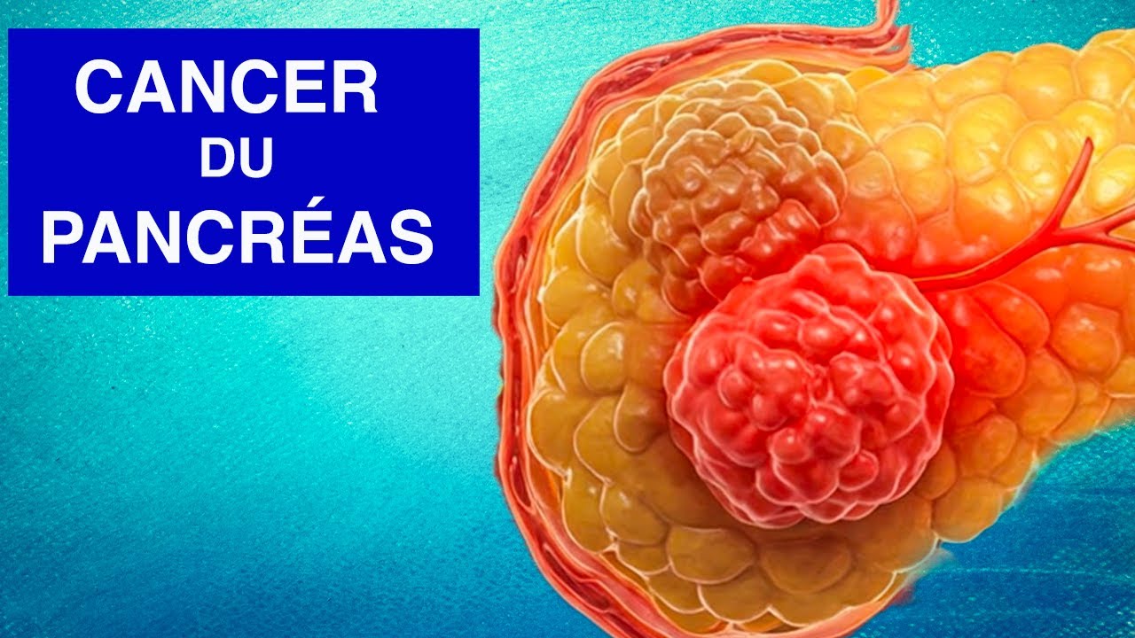 CANCER DU PANCR&Eacute;AS : Sympt&ocirc;mes et Traitements