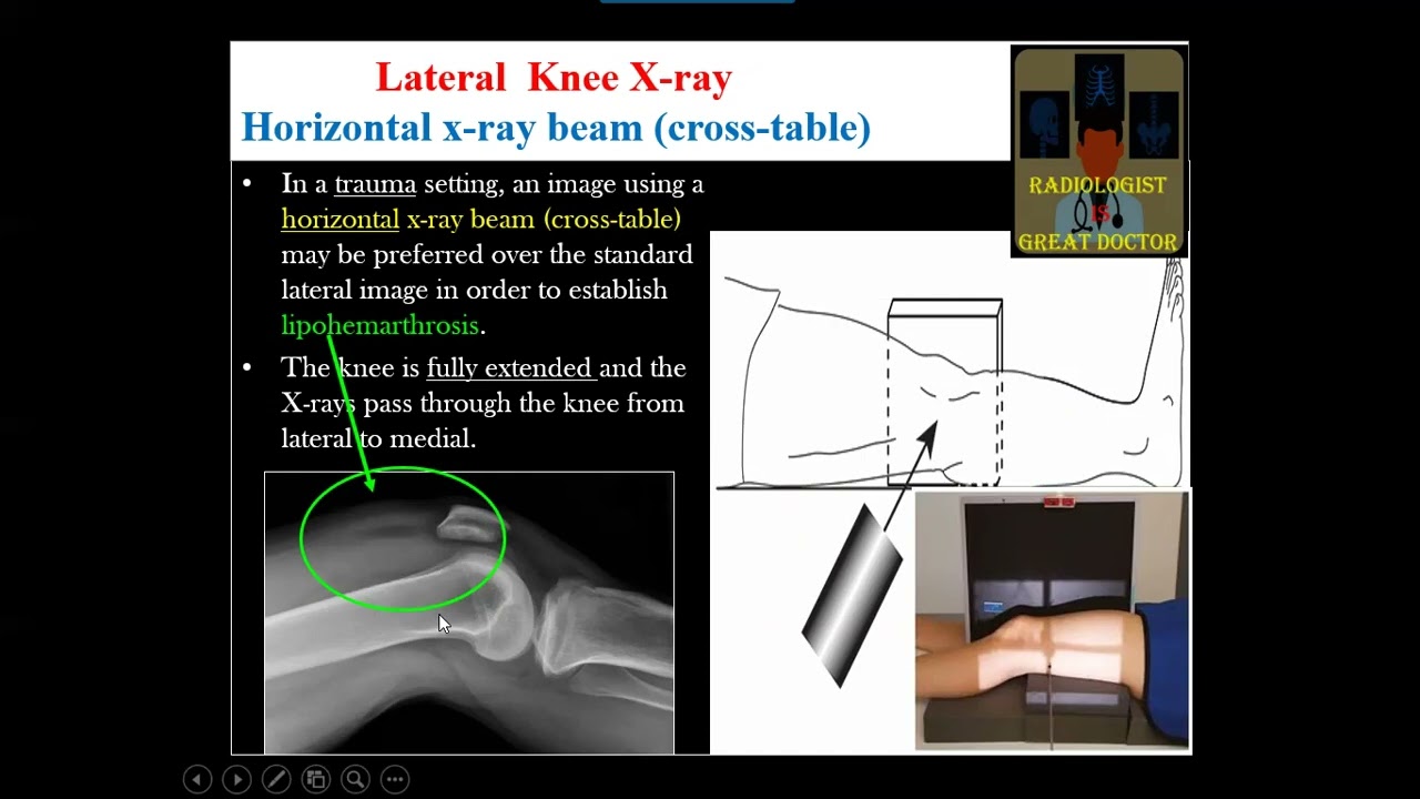 Knee X-ray of Lipohaemarthrosis