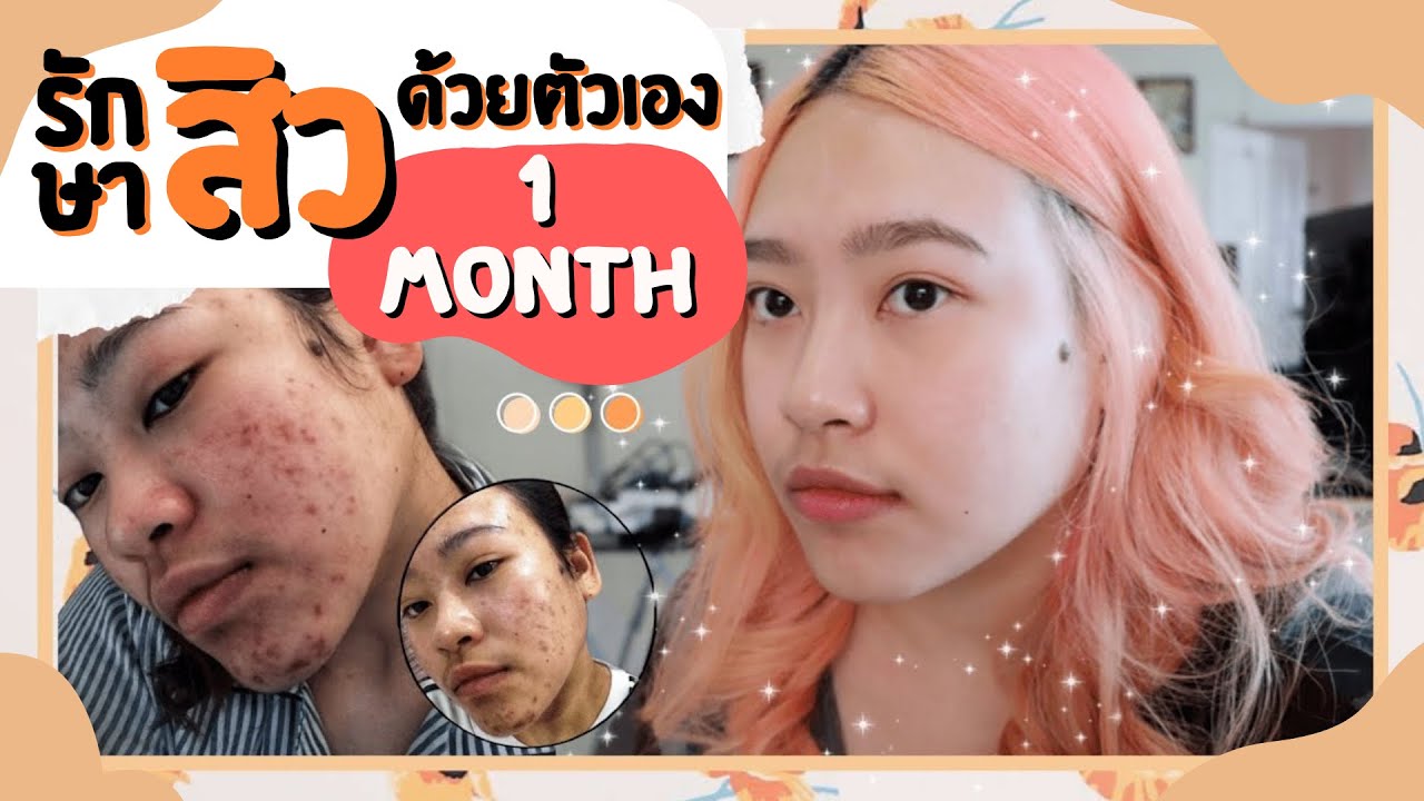 รักษาสิวด้วยตัวเองใน 1 เดือน แบบไม่เจ็บตัว 🎉 ทำยังไง ใช้อะไร บอกหมดไม่กั๊ก┃nownow p.
