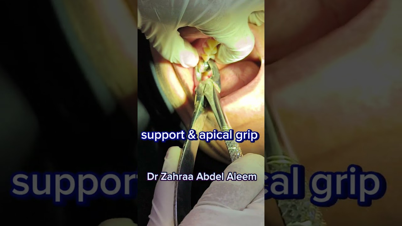 extraction vertically fractured upper 6