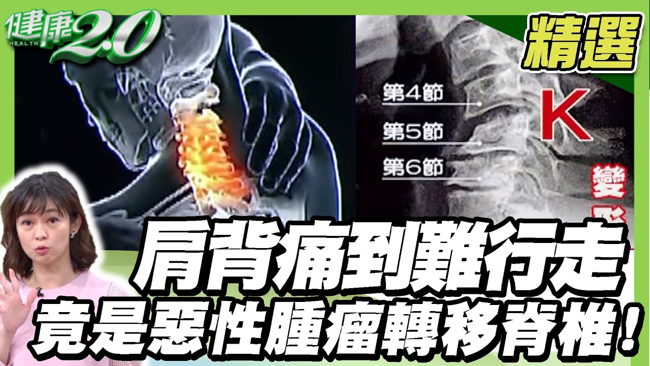 輕忽 頸椎神經壓迫 恐致手腳發麻、癱瘓！肩背痛到難行走 竟是惡性腫瘤轉移脊椎！釋放頸椎壓力這樣動！【健康2.0精選】
