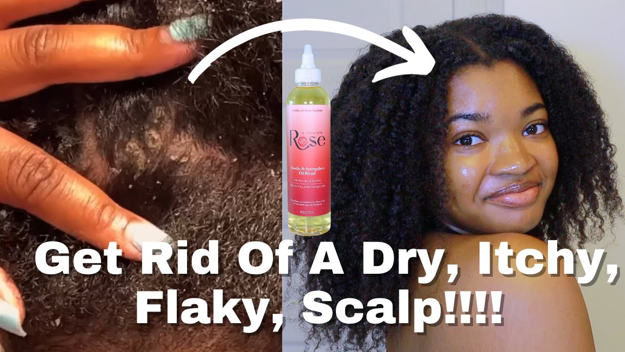 HOT OIL TREATMENT for Dry, Itchy, Flaky Scalp!!! | ft. A Naturale Rose Soothe & Strengthen Oil Blend