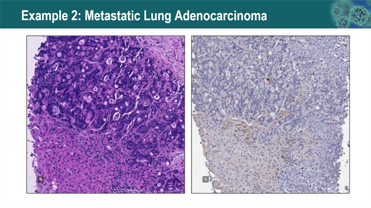 Update on Immuno-Oncology Biomarkers