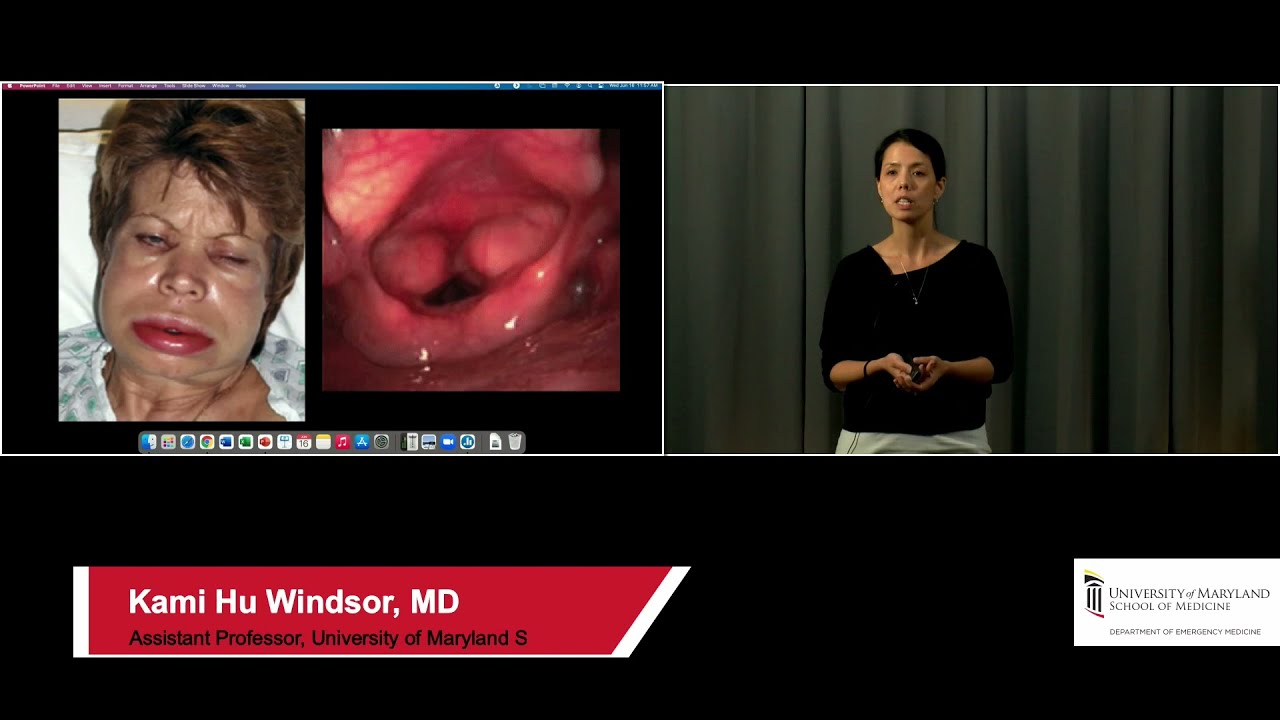Extubating in the ED --Kami Hu Windsor, MD