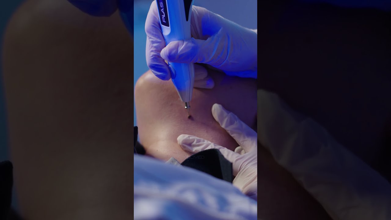 REMOVENDO VERRUGAS COM A CANETA PLASMAX
