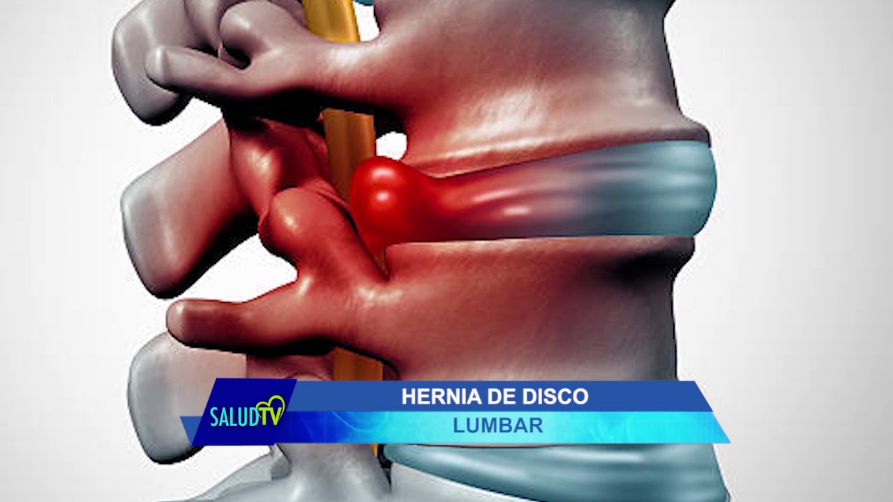 Hernia de disco lumbar