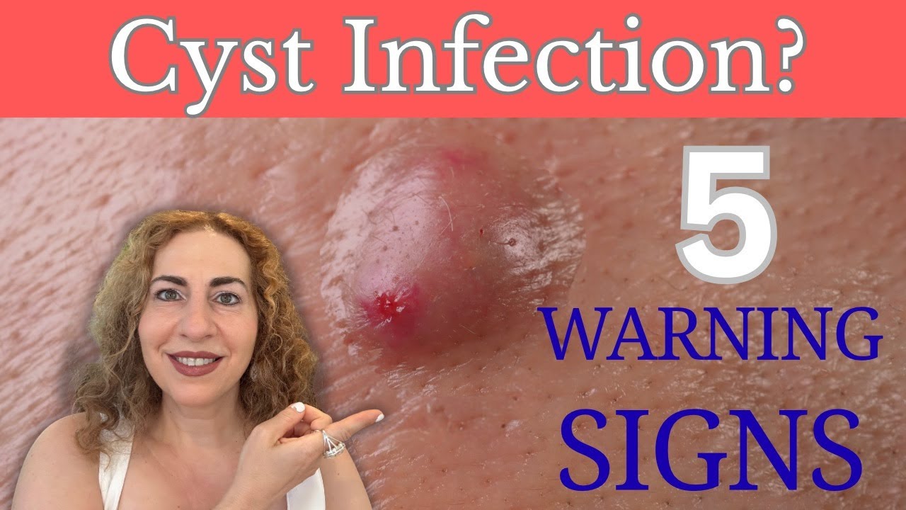 Is Your Cyst Infected? Early Signs You Shouldn&rsquo;t Ignore!