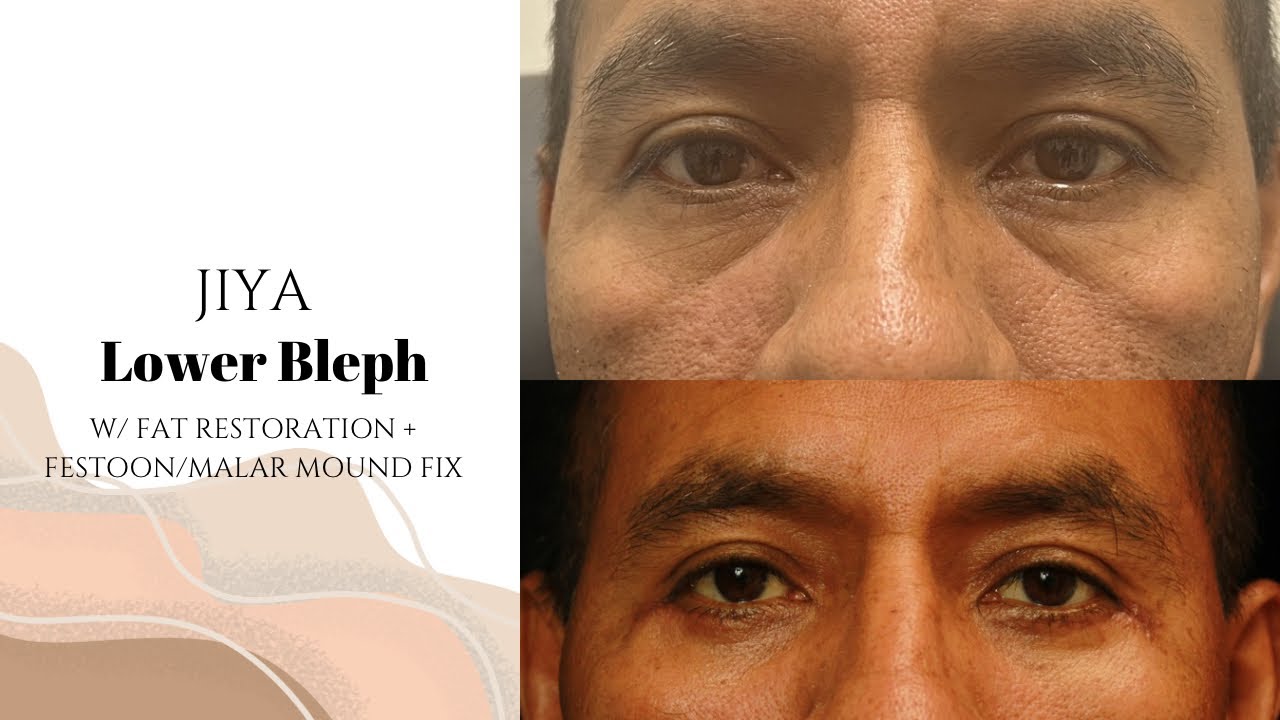 JIYA | Lower Bleph w/ Fat Grafting + Festoon/Malar mound fix