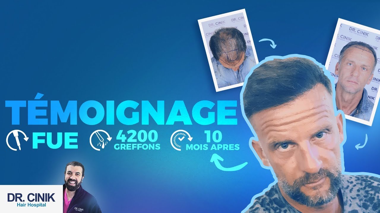 Clinique De Transplantation De Cheveux Dr.Cinik | FUE - 4200 Greffes | Examen