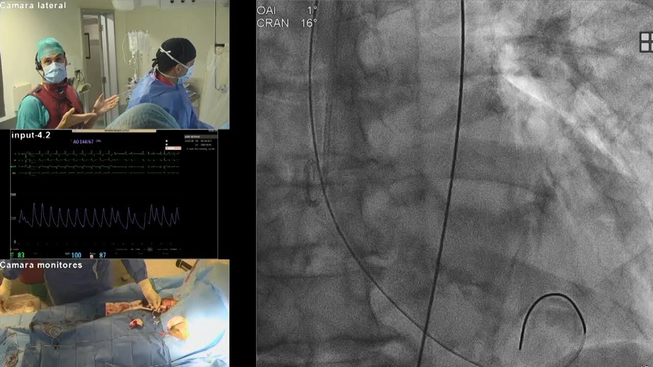 Single operator TAVI: where expertise meets consistency - PCR London Valves 2025