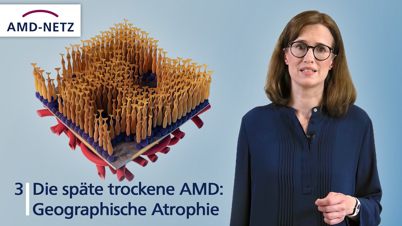 3. Die späte trockene AMD: Geographische Atrophie