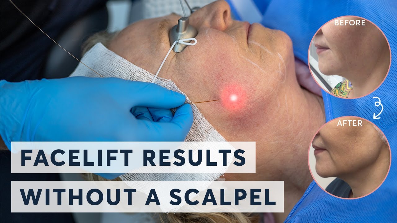 Want Younger, Smoother Skin? See How Endolift Erases Wrinkles Without Surgery!
