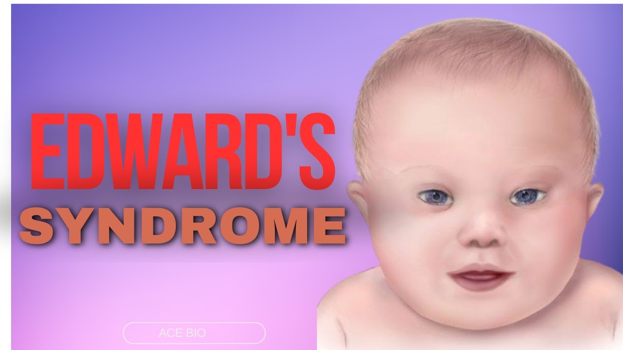 Edwards Syndrome (Trisomy 18) Explained: Causes, Symptoms & Diagnosis |