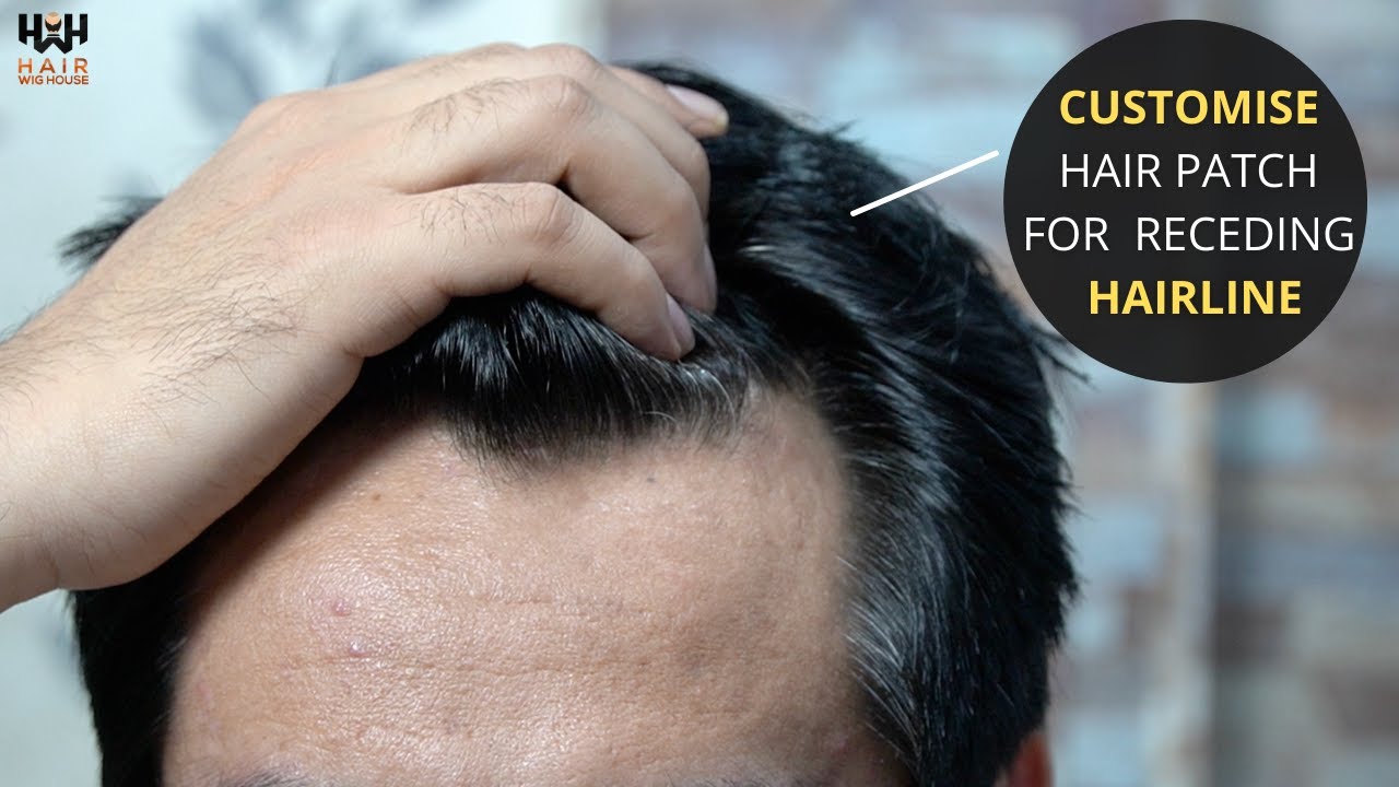 Hairline Receding Solution | Customised Hairline Patch | Hair wig house