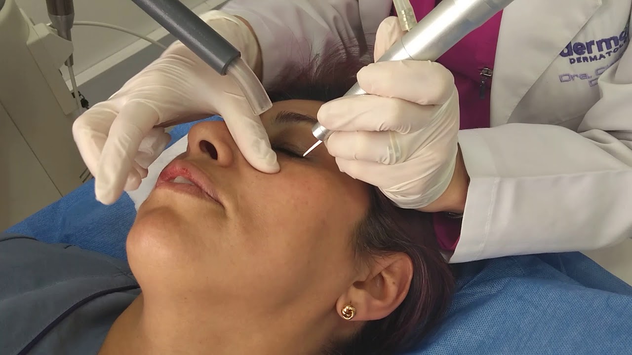 Láser Co2 Ablativo - Dermosalud